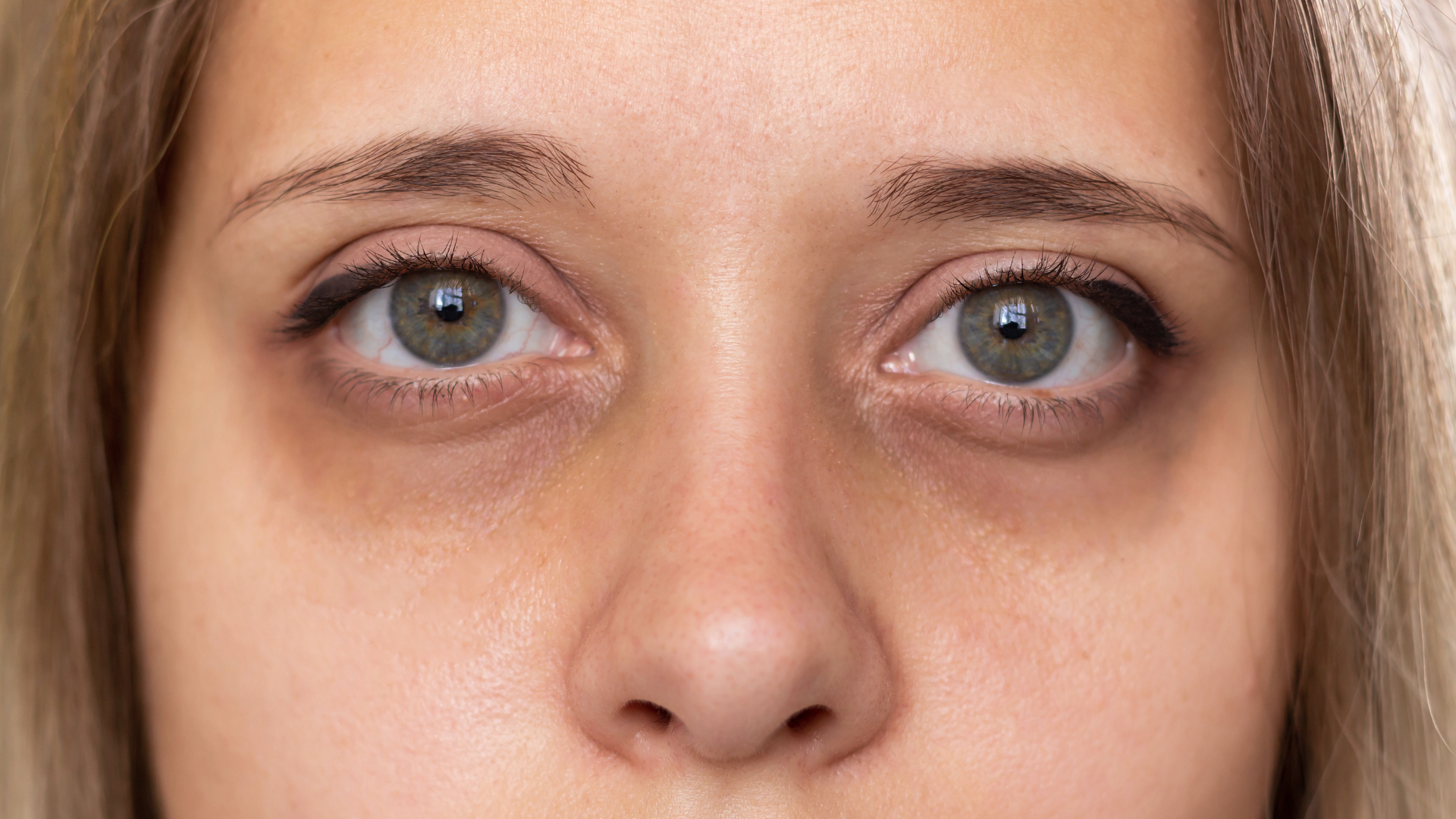 Correção de olheiras com ácido hialurônico: como funciona e vantagens